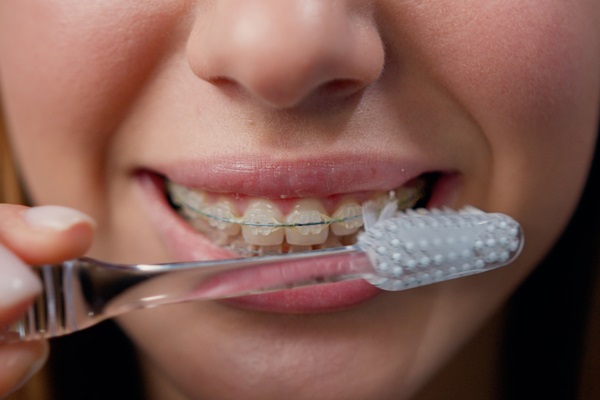 How To Maintain Your Oral Health With Clear Braces From A General Dentist