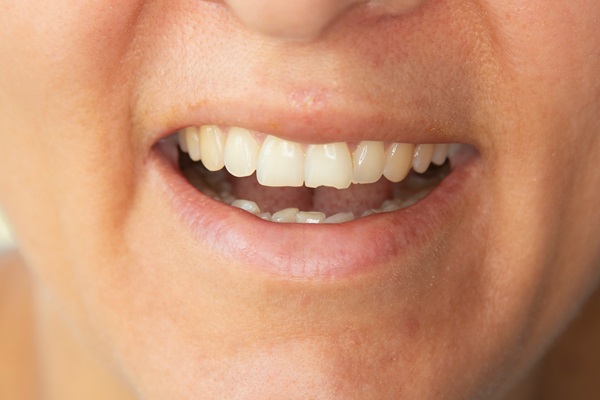 Can A Dentist Save A Cracked Tooth?