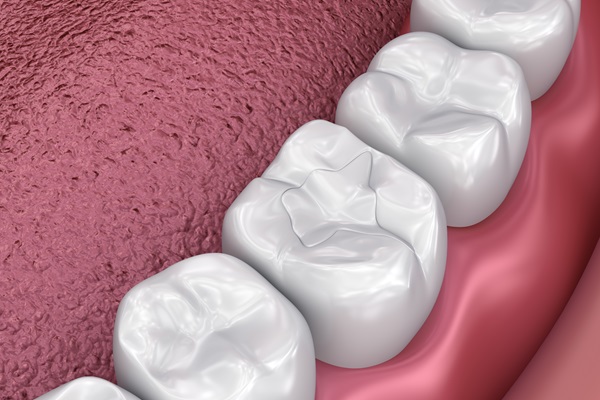 Tooth Colored Fillings FAQs